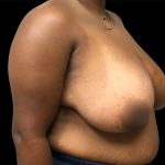Breast Reduction Before & After Patient #6545
