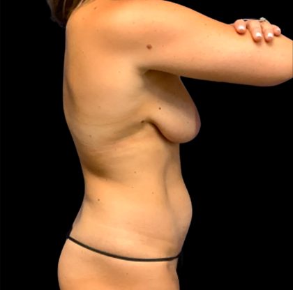 Tummy Tuck Before & After Patient #6562