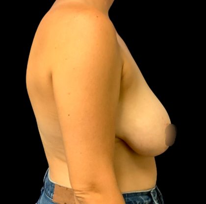 Breast Reduction Before & After Patient #6564