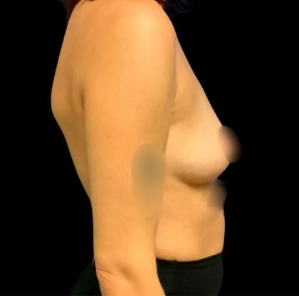 Breast Augmentation Before & After Patient #6547
