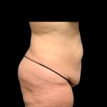 Tummy Tuck Before & After Patient #6567