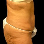 Tummy Tuck Before & After Patient #6568