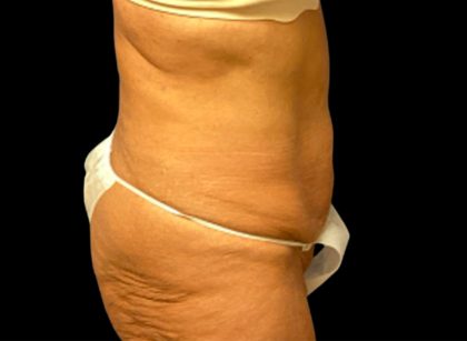 Tummy Tuck Before & After Patient #6568