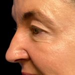 Blepharoplasty Before & After Patient #6570
