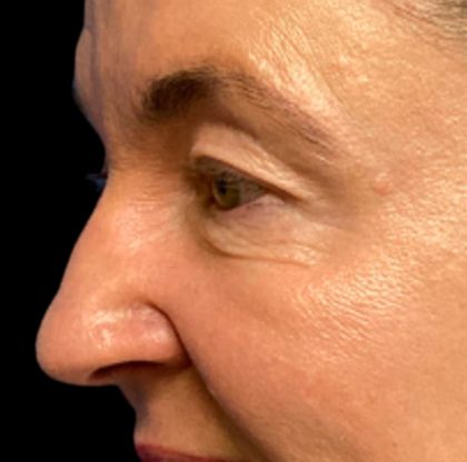 Blepharoplasty Before & After Patient #6570