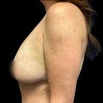 Breast Augmentation Before & After Patient #6571