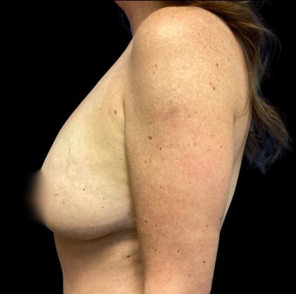 Breast Augmentation Before & After Patient #6571