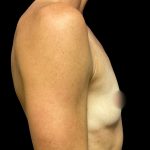 Breast Augmentation Before & After Patient #6572