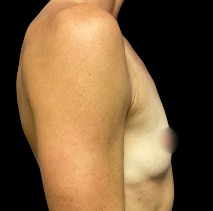 Breast Augmentation Before & After Patient #6572