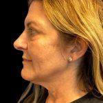 Facelift Before & After Patient #6573