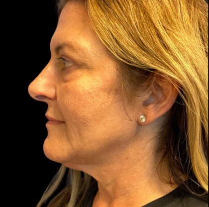 Facelift Before & After Patient #6573
