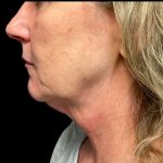 Facelift Before & After Patient #6574