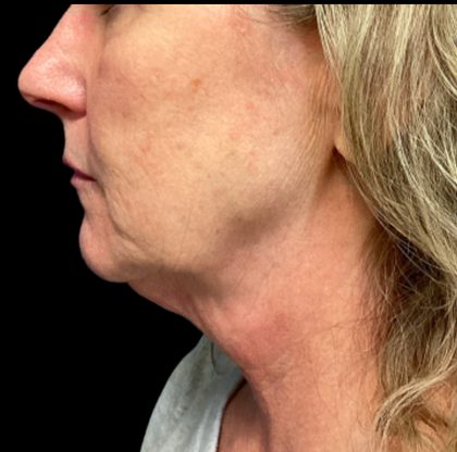 Facelift Before & After Patient #6574