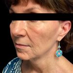 Facelift Before & After Patient #6575