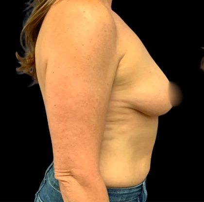 Breast Augmentation Before & After Patient #6548