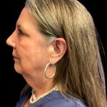 Facial Fat Grafting Before & After Patient #6576