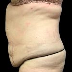 Liposuction Before & After Patient #6577