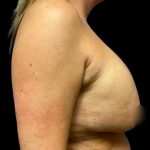 Implant Removal Before & After Patient #6578