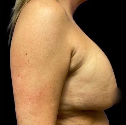 Implant Removal Before & After Patient #6578