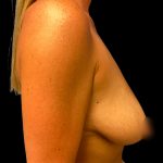 Mastopexy Augmentation Before & After Patient #6581