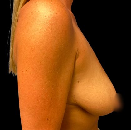 Mastopexy Augmentation Before & After Patient #6581