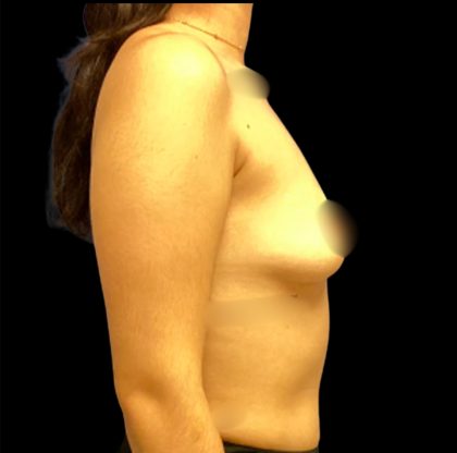Breast Augmentation Before & After Patient #6549