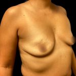 Breast Augmentation Before & After Patient #6551