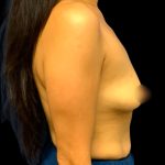 Breast Augmentation Before & After Patient #6552