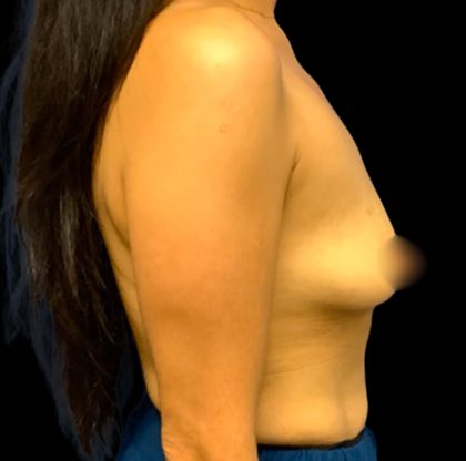 Breast Augmentation Before & After Patient #6552