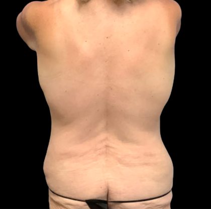 Circumferential Abdomen Before & After Patient #6553