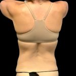 Circumferential Abdomen Before & After Patient #6554