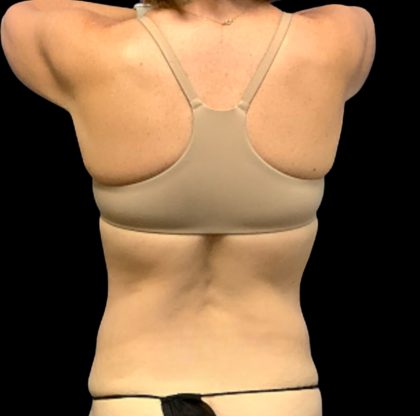 Circumferential Abdomen Before & After Patient #6554
