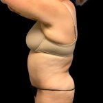 Tummy Tuck Before & After Patient #6546