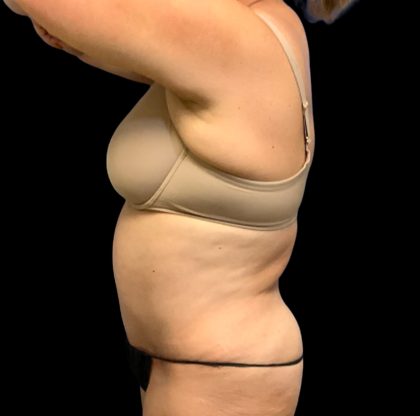 Tummy Tuck Before & After Patient #6546