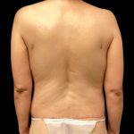 Circumferential Abdomen Before & After Patient #6555
