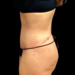 Circumferential Abdomen Before & After Patient #6556
