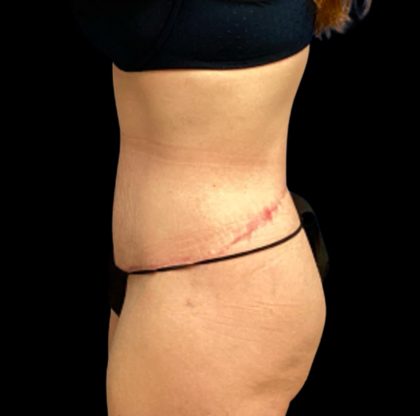 Circumferential Abdomen Before & After Patient #6556