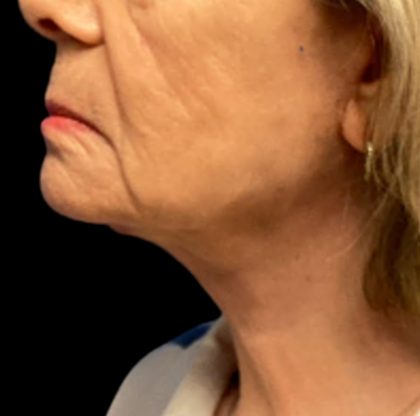 Facelift Before & After Patient #6557