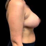 Mastopexy Augmentation Before & After Patient #6558
