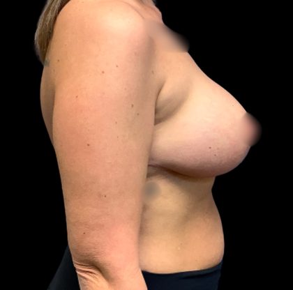Mastopexy Augmentation Before & After Patient #6558