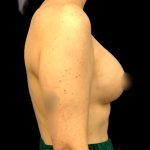 Mastopexy Augmentation Before & After Patient #6559