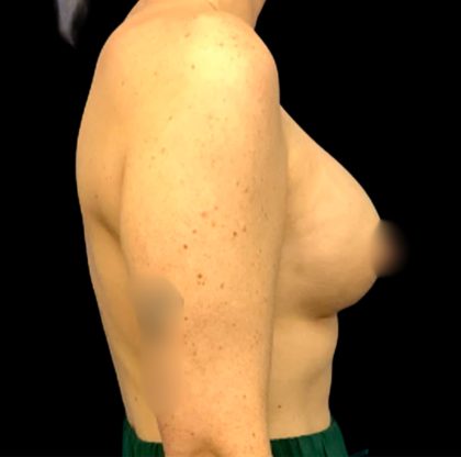 Mastopexy Augmentation Before & After Patient #6559