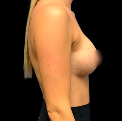 Mastopexy Augmentation Before & After Patient #6563