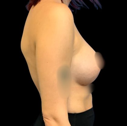Breast Augmentation Before & After Patient #6547