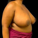 Breast Reduction Before & After Patient #6565