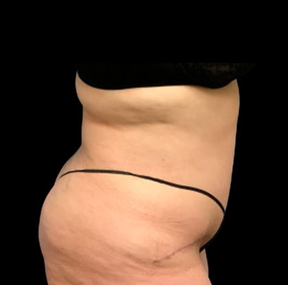 Tummy Tuck Before & After Patient #6567