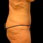 Tummy Tuck Before & After Patient #6568