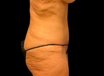 Tummy Tuck Before & After Patient #6568