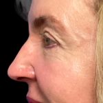 Blepharoplasty Before & After Patient #6570