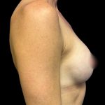 Breast Augmentation Before & After Patient #6572